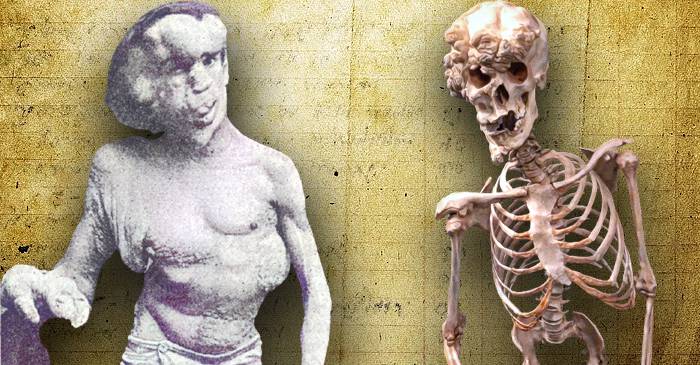 Povestea tragică a lui Joseph Merrick, omul-elefant