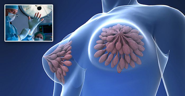 Patru oameni au făcut cancer de sân după ce au primit organe de la același donator FEATURED_compressed