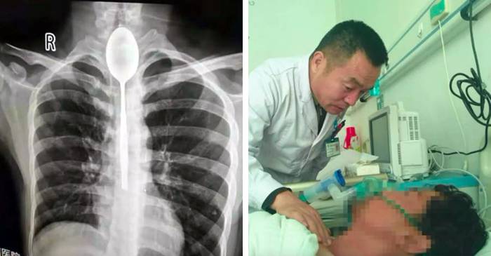 Chinezul care a trăit timp de un an cu o lingură în esofag FEATURED_compressed