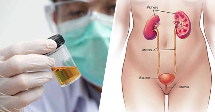 Boala fără nume Femeia a cărei vezică urinară produce alcool