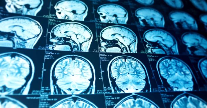 O creștere alarmantă de abcese cerebrale a fost observată la copii
