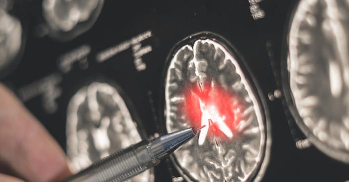 Scleroza laterală amiotrofică distruge neuronii motori și paralizează corpul în timp ce mintea rămâne lucidă