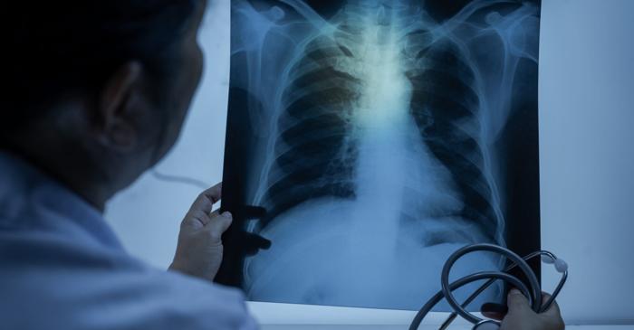 Trei compuși experimentali atacă tuberculoza prin perturbarea sistemului de reciclare al bacteriei