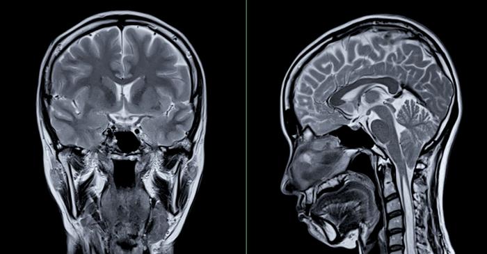 Vocile din capul unei femei i-au diagnosticat corect o tumoare pe creier