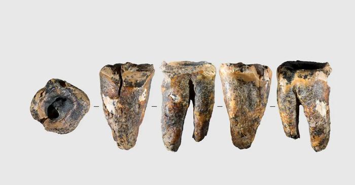 Un dinte de neanderthalian arată cum se tratau cariile în epoca de piatră